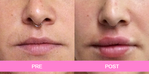aumento labial antes y despues