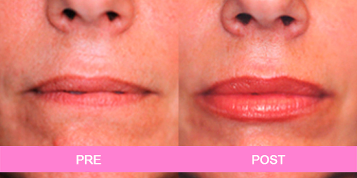 aumento labial antes y despues