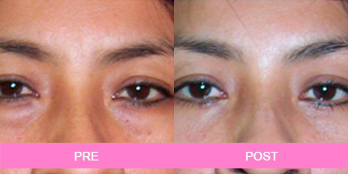 blefaroplastia antes y despues