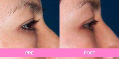 blefaroplastia antes y despues