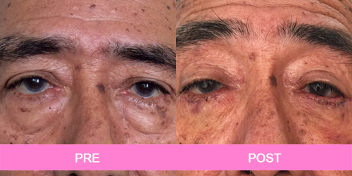 blefaroplastia antes y despues