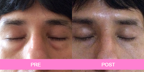 blefaroplastia antes y despues