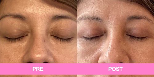 blefaroplastia antes y despues