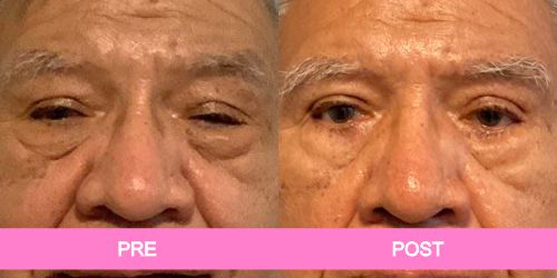 blefaroplastia antes y despues