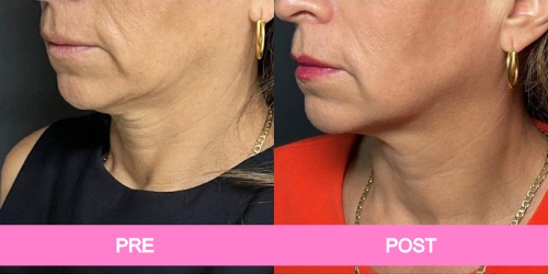 implante pantorrillas antes y despues