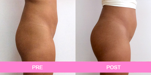 aumento de gluteos antes y despues