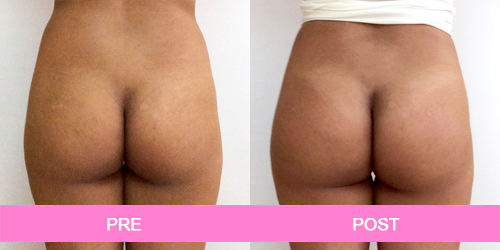 aumento de gluteos antes y despues