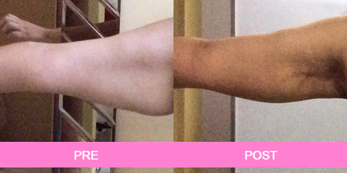 lifting de brazos antes y despues