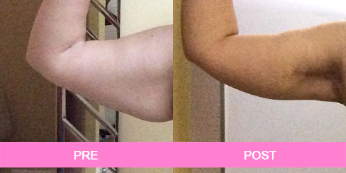 lifting de brazos antes y despues
