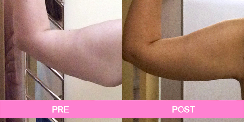 lifting de brazos antes y despues