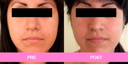 lipoescultura facial antes y despues